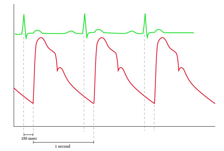 Normal arterial line waveforms Deranged Physiology